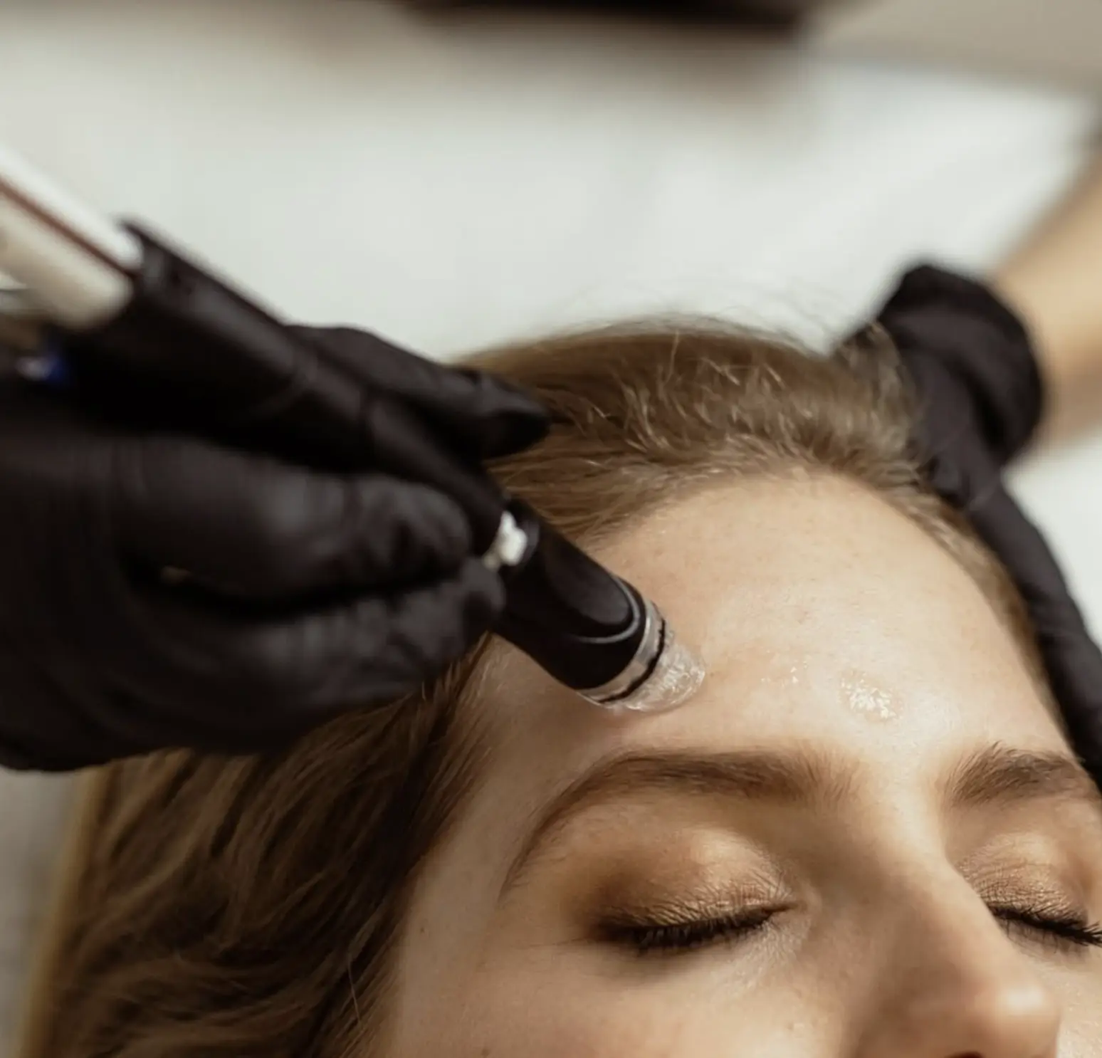 does microdermabrasion remove pigmentation